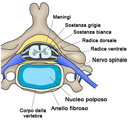 Ernia discale vertebrale