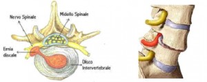Ernia discale vertebrale 2