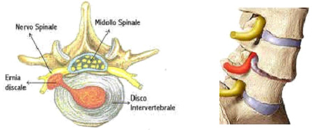 Ernia discale vertebrale 2