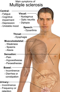 Sintomi della sclerosi multipla