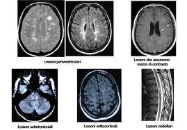 Diagnosi della sclerosi multipla
