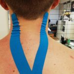 kinesiotaping cervicalgia