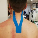 kinesio cervicalgia dopo onde durto