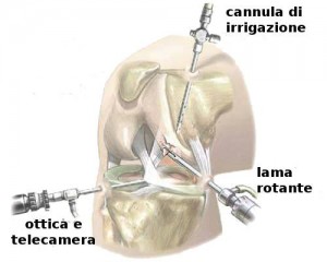 artroscopia del ginocchio 1