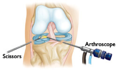 artroscopia del ginocchio 2