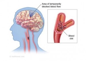 attacco ischemico transitorio