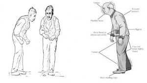 morbo di parkinson rigidità