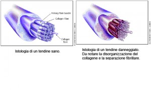 tendinopatia