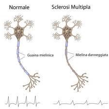 Effetti della sclerosi multipla sui neuroni