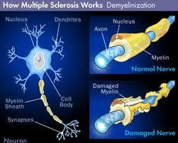 Effetti della sclerosi multipla sui neuroni