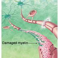 Effetti della sclerosi multipla sui neuroni