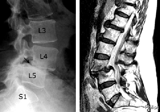 stenosi-canale-vertebrale2