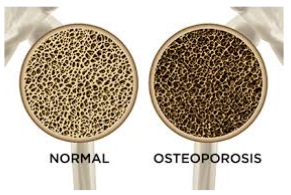 osteoporosi e tessuto osseo